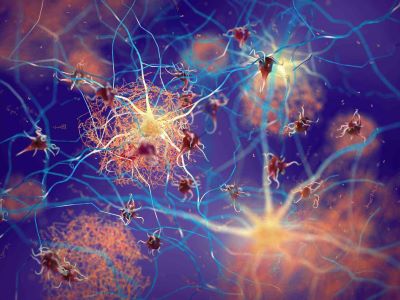 Alzheimer: identificate 75 regioni del DNA associate al rischio di malattia
